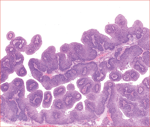 Laryngeal papillary squamous cell carcinoma, one of the rare histological variants of squamous cell cancer of the larynx, with its typical branching papillary architecture.