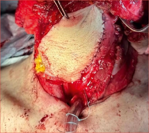 Insetting of an antero-lateral thigh free flap. First, the suture between the residual mucosa and the flap on the right is completed, followed by the second suture on the left side of the mucosa to complete the pharyngoplasty.