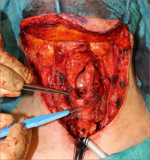 Modular OPHL: cricoid ring dissection after frozen sections.