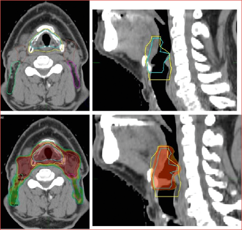 Radiotherapy target volumes and dose distribution after OPHL type II for pT3- N2c supraglottic carcinoma.
