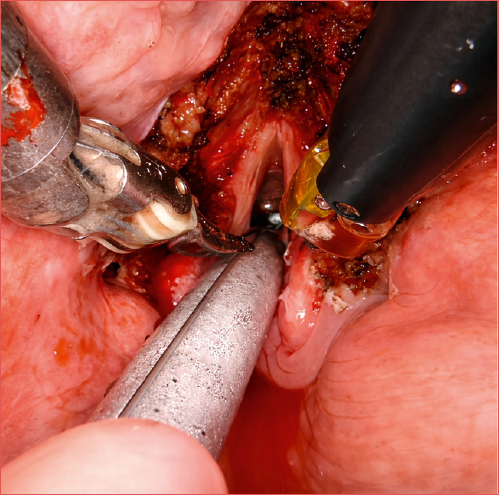 Intraoperative image of transoral robotic surgery supraglottic laryngectomy.