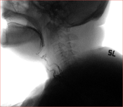 Phonatory air bubble with irregular morphology of sigmoid shape.