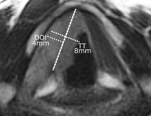 Magnetic resonance, axial T2-weighted image at the level of the glottic plane of a glottic cT2 with impaired vocal cord mobility. On the right side, the tumour involves the entire vocal cord (from the arytenoid cartilage to the anterior commissure). The hypointense signal of the vocalis muscle is effaced (compare for clarity with the contralateral side). Tumour thickness (TT) is 8 mm, while depth of tumour invasion (DOI) is 4 mm. The difference between TT and DOI reflects the tumour exophytic component, which should not be included in the DOI measurement.
