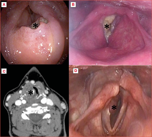 Challenging airway management in laryngeal cancer (*). Preoperative fibroendoscopy of locally advanced laryngeal squamous cell carcinoma: supraglottic (A) and glottic site (B). Typical subglottic stenosis of a cricoid chondrosarcoma, visible in axial CT scan with contrast enhancement (C) and fiberoptic evaluation (D).