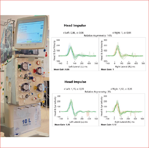 Head impulse test of a patient on haemodialysis who was included in the study.