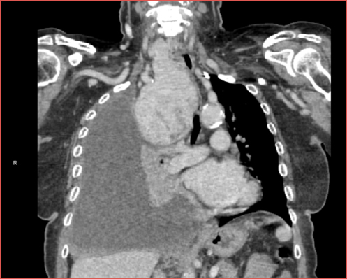 A huge secondary intrathoracic goiter is shown in a 60-year-old woman. Despite not having a true iceberg-shape, the extension below the aortic arch and the collapsed right lung with the associated large pleural effusion should prompt the surgeon to choose for a combined transcervical and transthoracic approach in order to minimise complications.