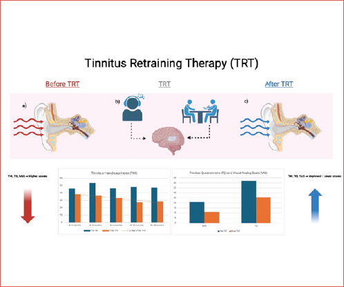 Tinnitus retraining therapy (TRT) reduces tinnitus severity and promotes habituation, reflected in decreased scores of Tinnitus Handicap Index, Tinnitus Questionnaire, and Visual Analogue Scale, alleviating auditory, emotional, and autonomic burden. A) Red arrows represent tinnitus perception, emotional distress, annoyance, and negative impact; B) TRT fundamentals: sound therapy and counselling; C) Bue arrows represent reduced tinnitus perception, improved emotional state, and successful habituation.