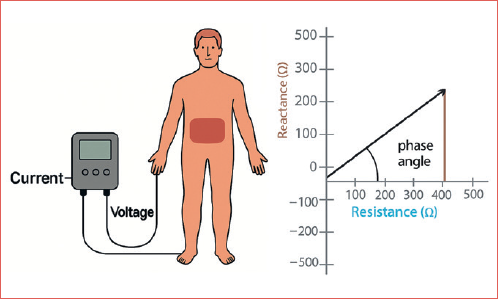 Illustration of a patient undergoing bioelectrical impedance analysis and a graph representing the meaning of phase angle, indicating the ratio between resistance and reactance.