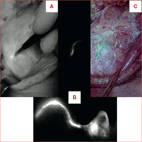 Different modalities of real-time fluorescence visualisation within the neck dissection field. A) monochromatic image of the near infrared (NIR)/indocyanine green (ICG) signal; B) pure NIR mode lymphatic stream and sentinel node intensity map; C) composite NIR/ ICG signal in the white light image (overlay green).