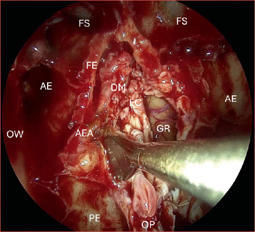 Intraoperative photo of an endoscopic anterior skull base resection, with opening of the dura mater in the left olfactory cleft. AE: anterior ethmoid; AEA: anterior ethmoidal artery; DM: dura mater; FC: falx cerebri; FE: fovea ethmoidalis edge; FS: frontal sinus; GR: gyrus rectus; OP: olfactory phyla; OW:orbital wall; PE: posterior ethmoid.