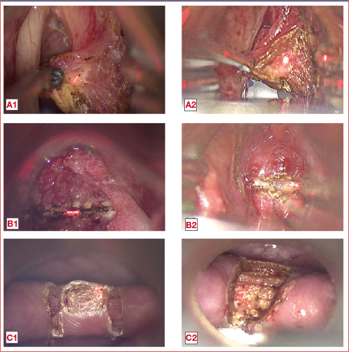 Comparison of different procedures performed by VITOM EAGLE or VITOM 3D: A1) Right type II cordectomy performed using VITOM EAGLE; A2) another case of right type II cordectomy, performed using VITOM 3D; B1) left cordectomy type V abcd using the VITOM EAGLE; B2) another case of left cordectomy type V abcd using the VITOM 3D; C1) Zenker’s diverticulotomy performed using VITOM EAGLE; C2) another case of Zenker’s diverticulum, surgically treated using VITOM 3D.