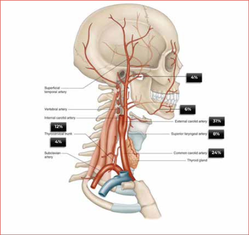 Major arterial branches in the head and neck area and their involvement in carotid blowout syndrome events (we thank Christopher P. Cheng and Elsevier for their contributions and permission to use this material).