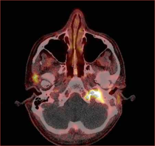 68 Ga-DOTATATE-PET/CT demonstrating intense uptake of the left recurrent middle ear neuroendocrine tumour at the level of the jugular foramen. The tumour extends into the hypoglossal canal, carotid canal, and the vertebral canal of C1.