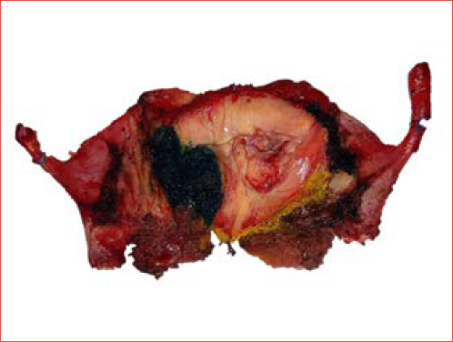 Surgical specimen of an OPHL type IIa showing green and yellow ink marks on the most delicate surgical margins to be evaluated by the pathologist.